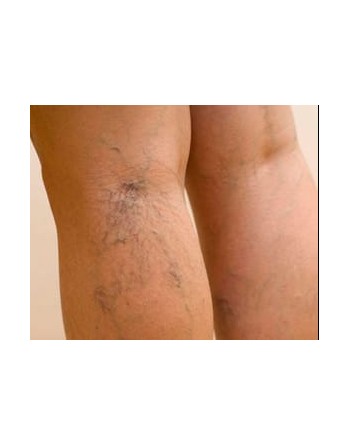 CREMA PARA VENAS VARICOSAS